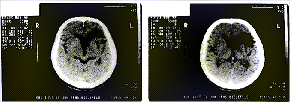 CT-Scan vom 23. März 1992