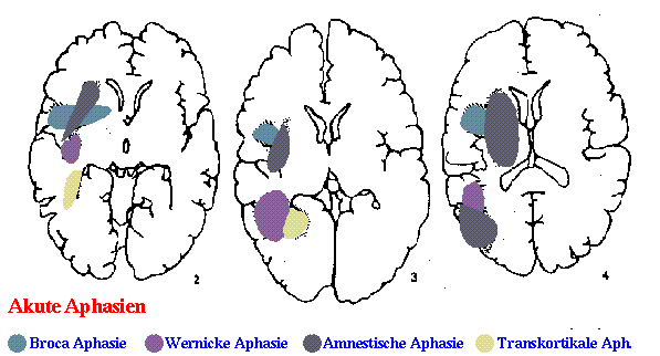 Lokalisation der Aphasien | Institute for Natural Language ...